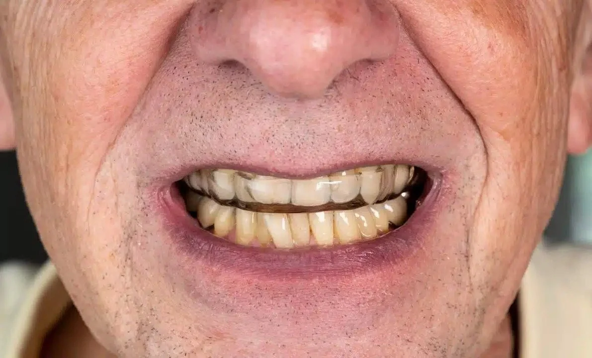 Can Stained Teeth Ever Be White Again?