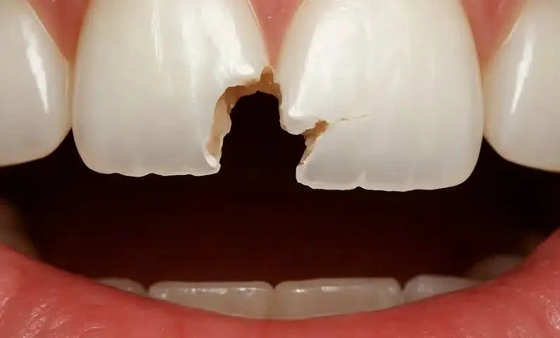 What Happens If A Broken Tooth Goes Untreated?