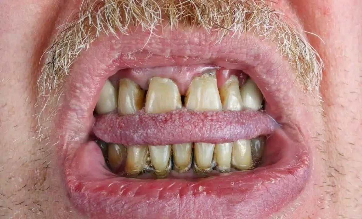 What Is The Fastest Way To Heal A Bitten Tongue?