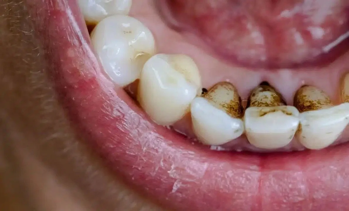 How To Get Rid Of Brown Stains On The Back Teeth?