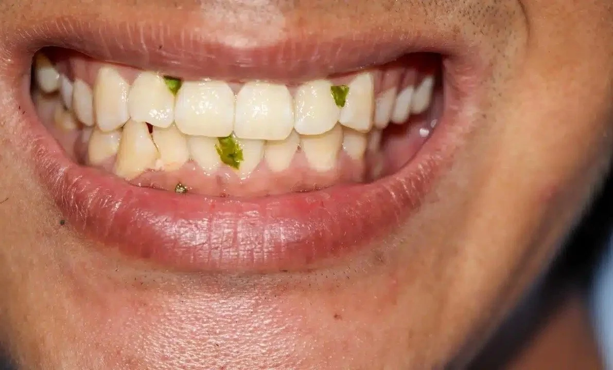 8 Effective Ways to Remove Food Stuck Between Your Teeth