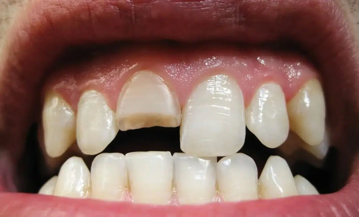 Emergency Solutions for a Fractured Tooth