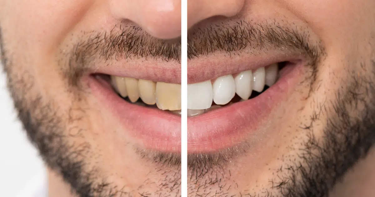 Teeth Whitening for Sensitive Teeth: What You Need to Know