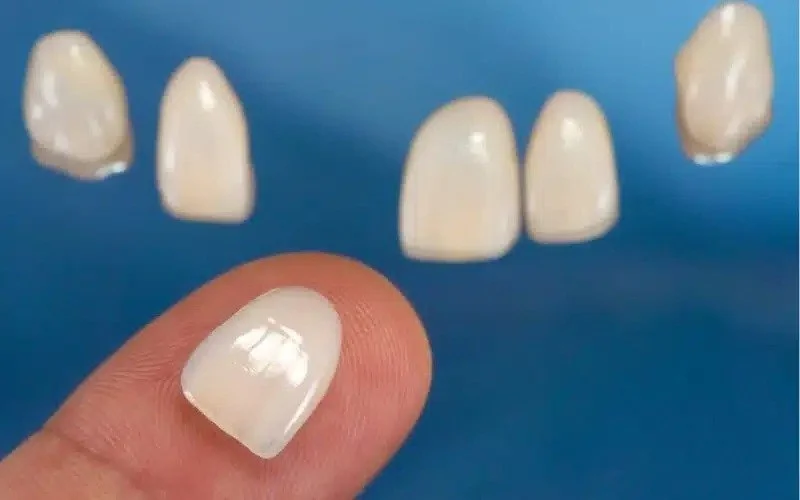 Know What You Should do If Your Veneer Falls off