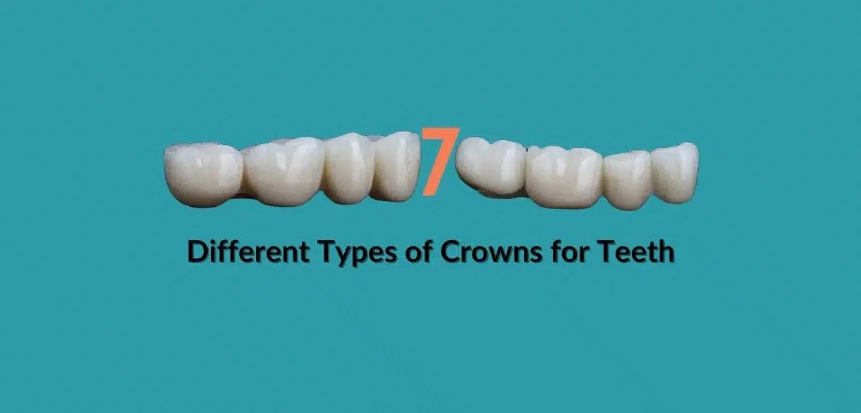 7 Different Types of Crowns for Teeth