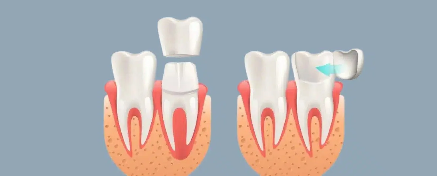Veneers vs. Crowns: Understanding the Difference for Your Smile