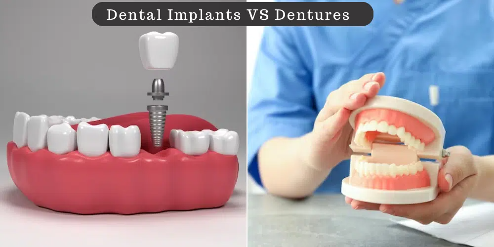 Get A Detailed Comparison Between Dental Implants and Dentures