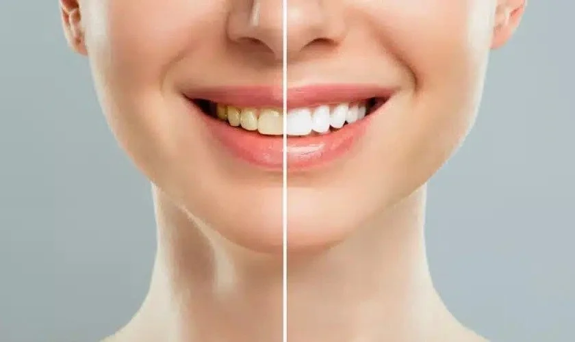 How Much Do Different Teeth Whitening Options Cost?