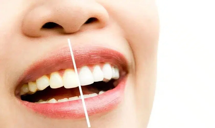 Say Cheese! Tips for a Camera-Ready Smile – Know about Teeth Whitening