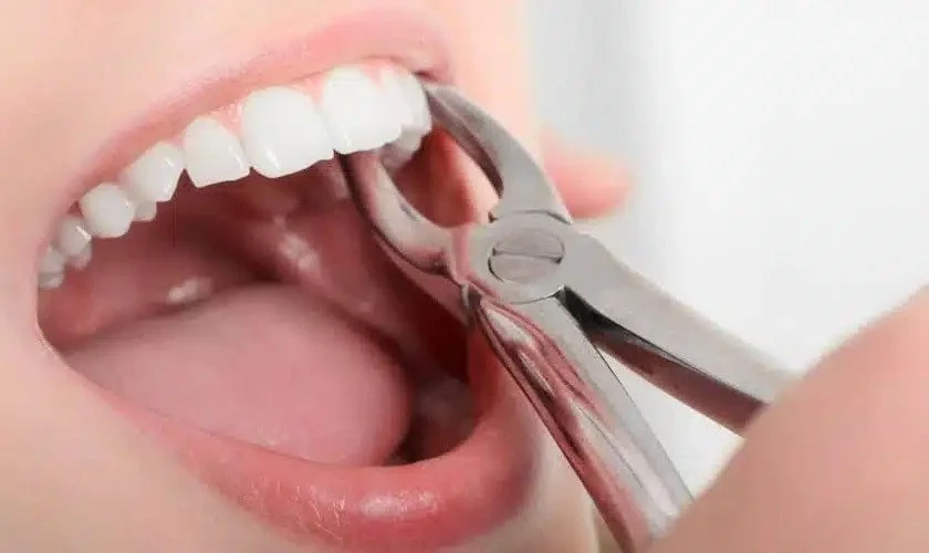 Preparing for a Tooth Extraction: Tips for a Smooth Experience