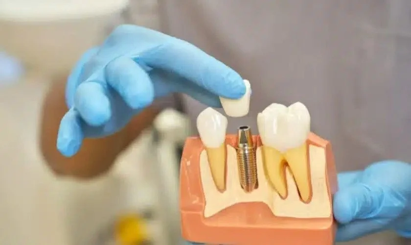 Understanding the Procedure and Recovery Process for Dental Implants