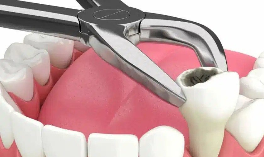 Tooth Extraction: Myths and Facts You Need to Know