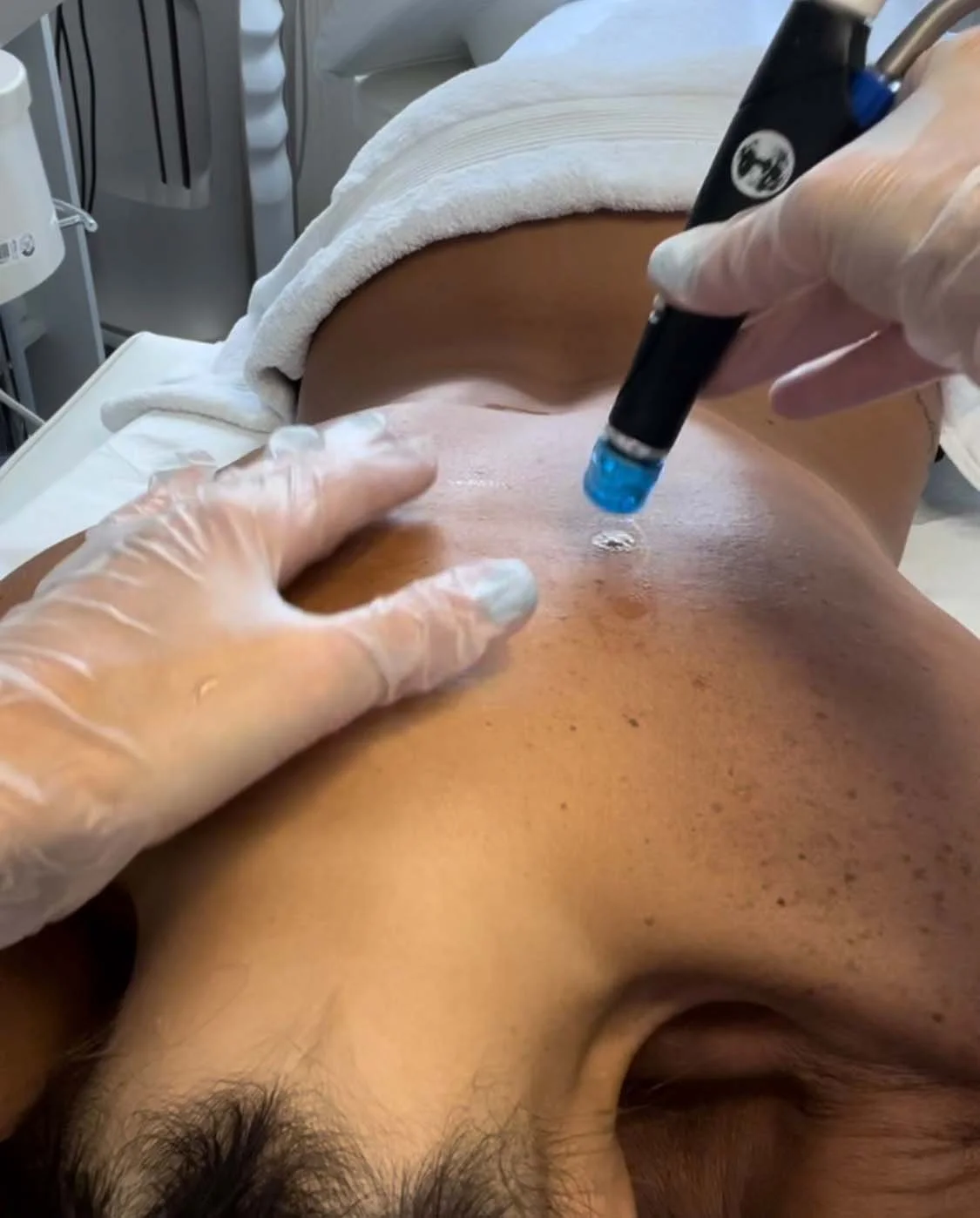 Rückenbehandlung Hydrafacial