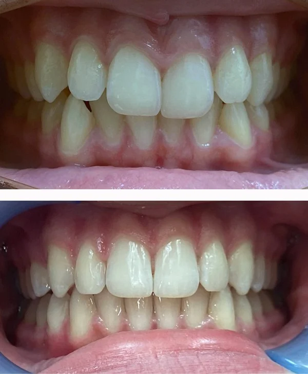 invisalign3.jpg