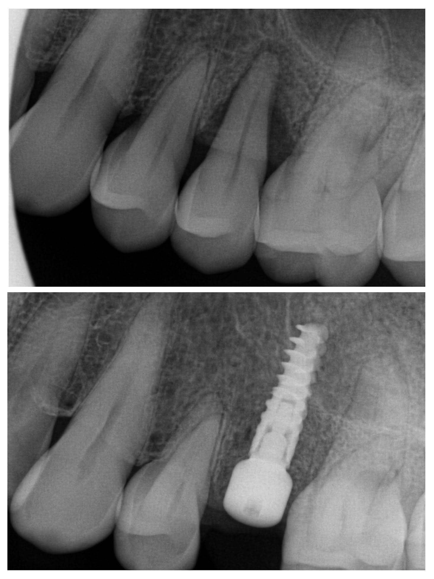 Extraction of tooth and placement of immediate implant