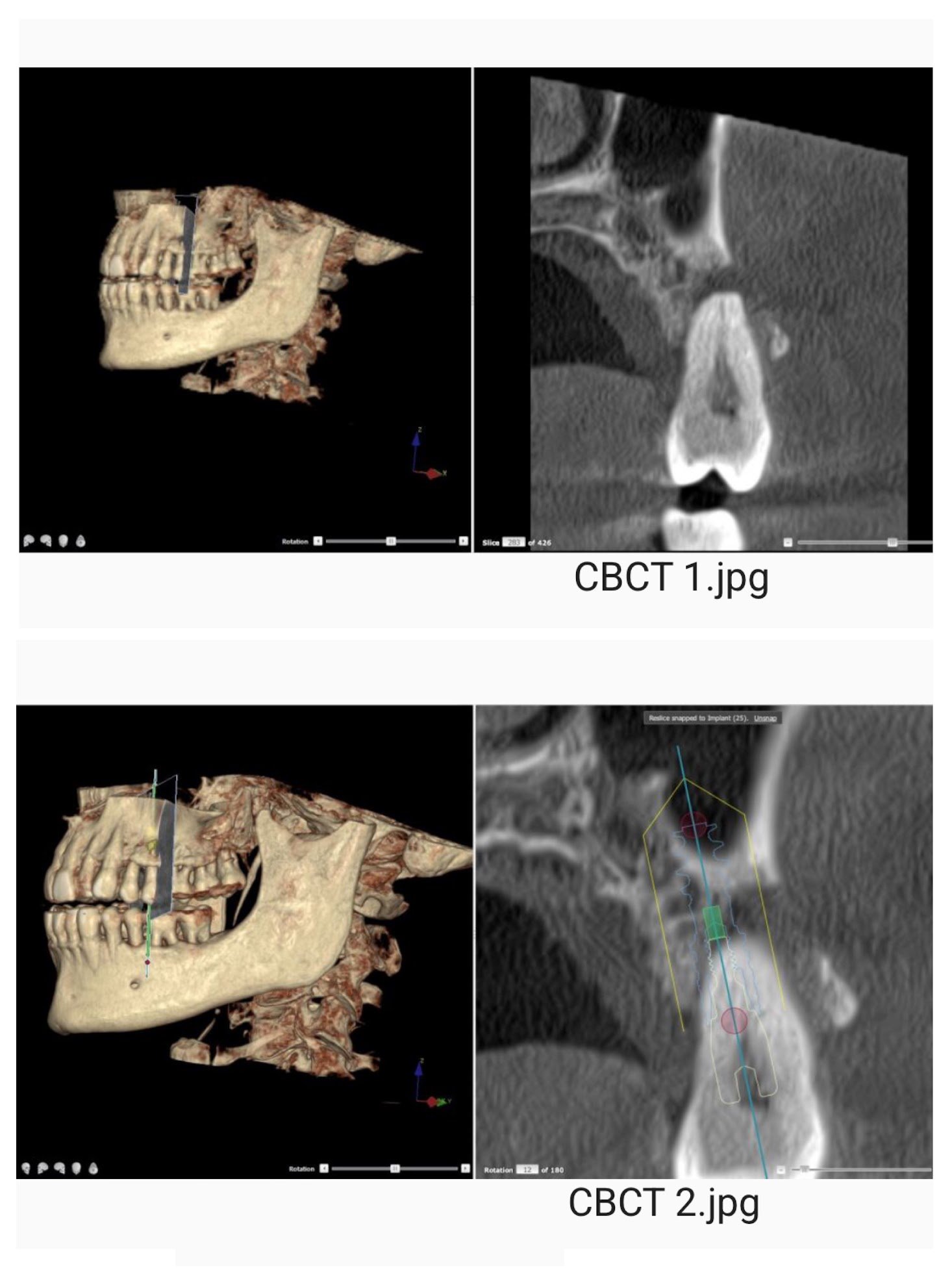 Implant Planning with CBCT imaging 