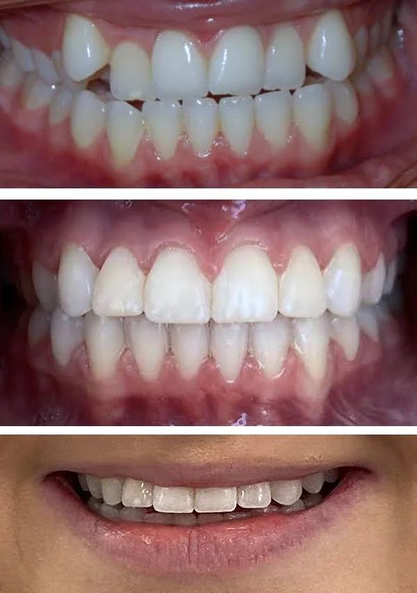 invisalign5.jpg