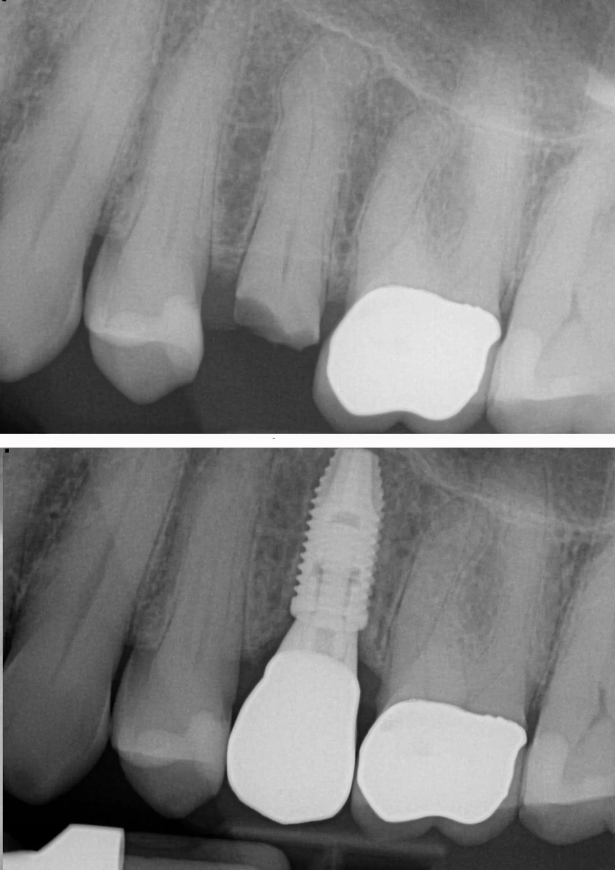 Tooth replacement with implant and crown