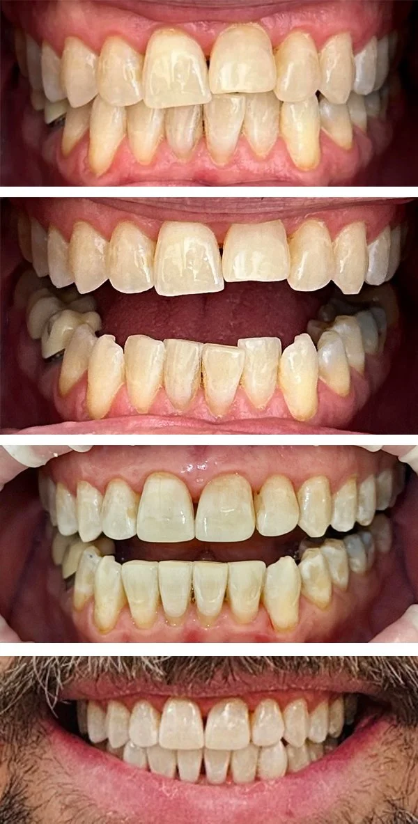 Invisalign6.jpg