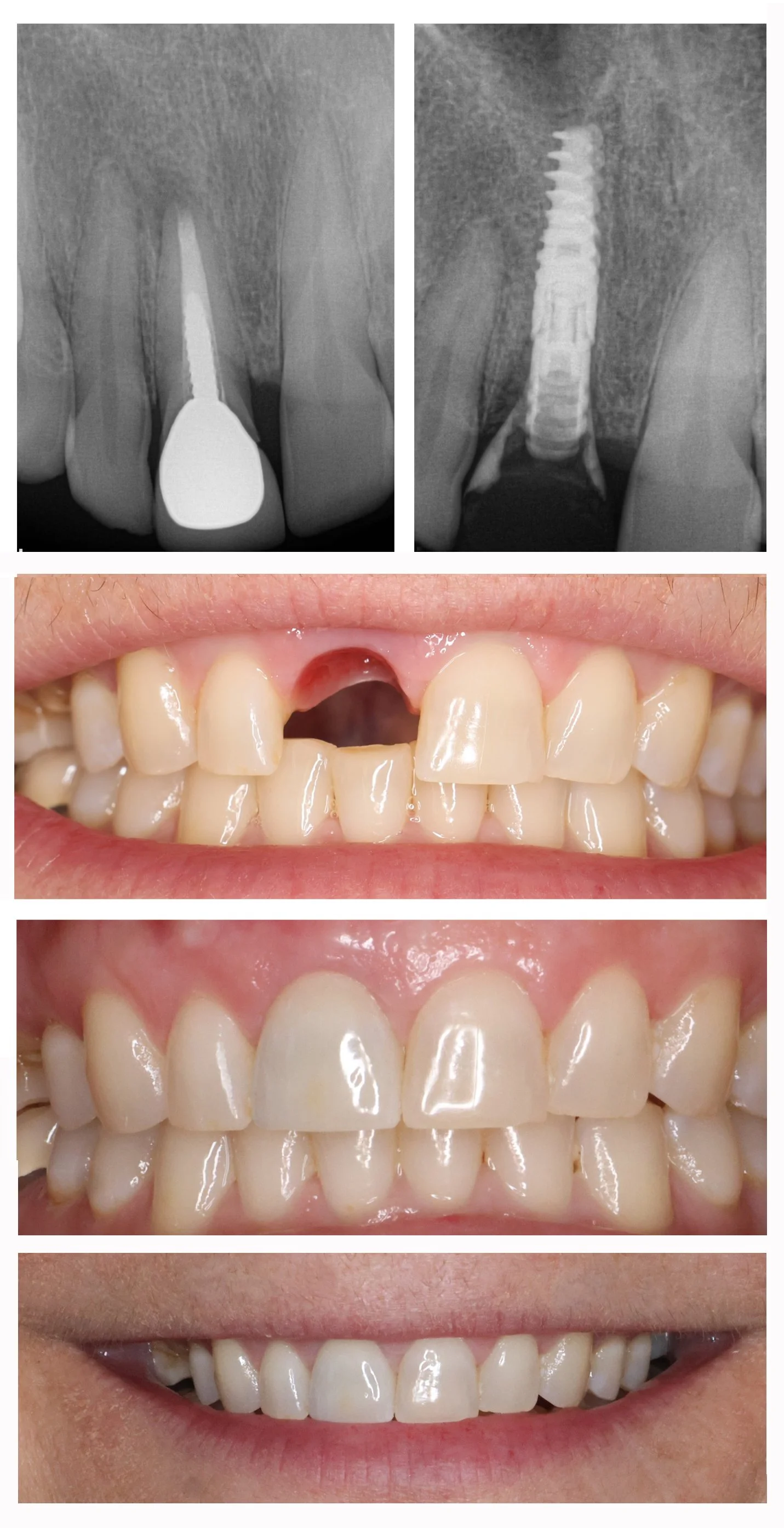 Before and after implant placement of front tooth, restored with custom crown