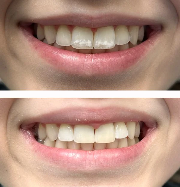 Bioclear restorations