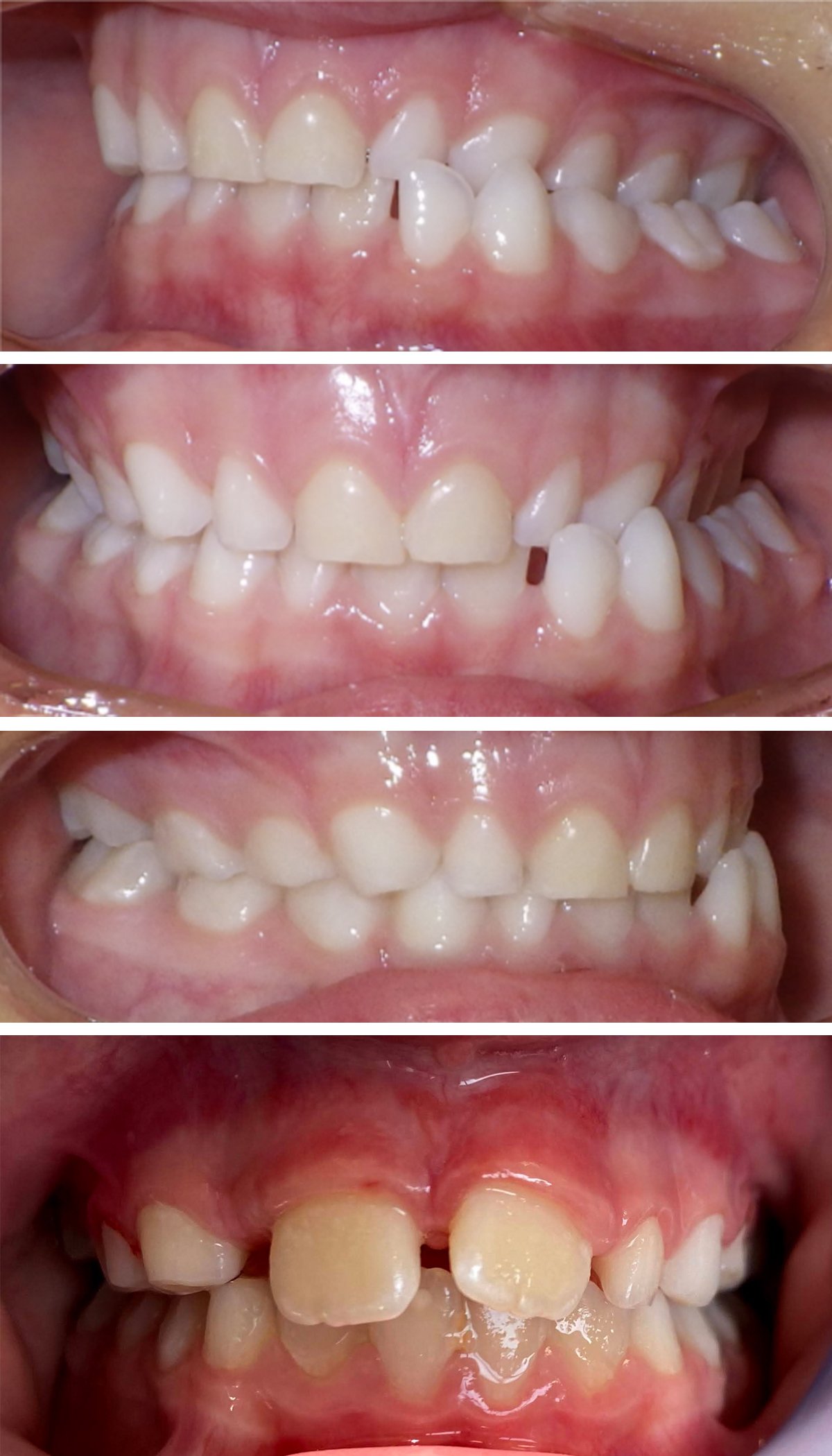 Before and after appliance