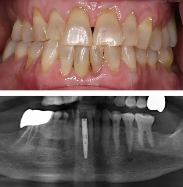 Lower front tooth replacement 