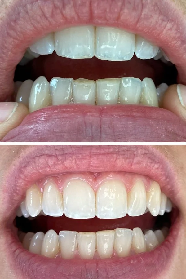 Tooth reshaping