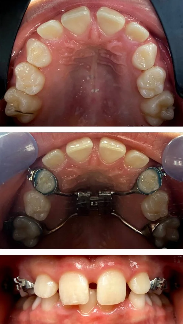 Orthodontic Appliance
