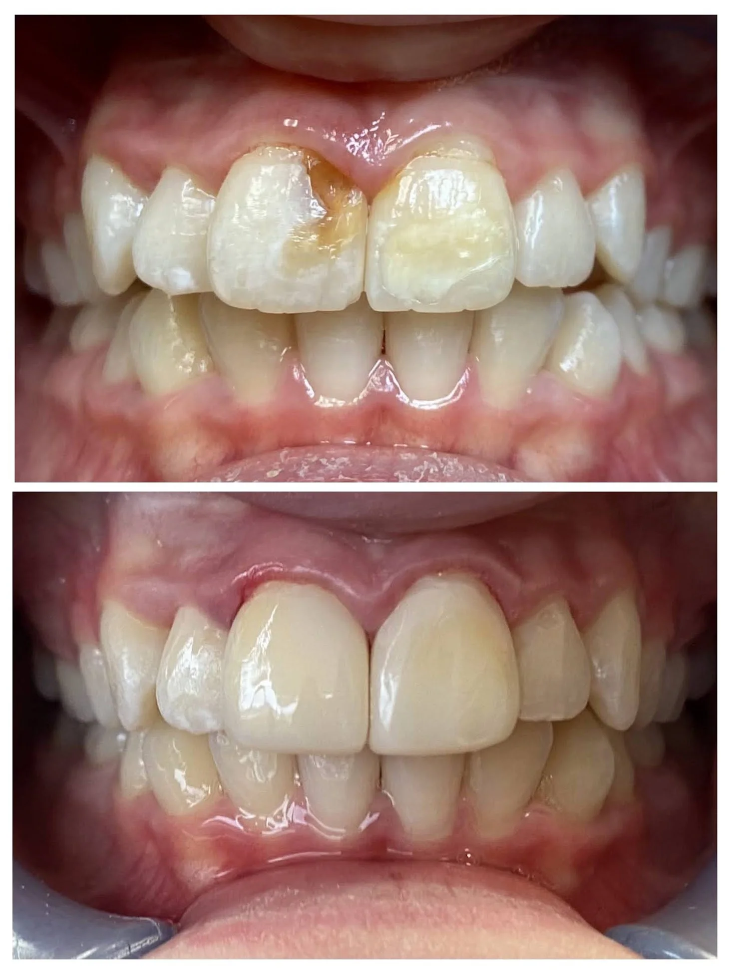Bioclear Restorations, bonding