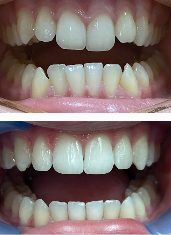 invisalign2.jpg