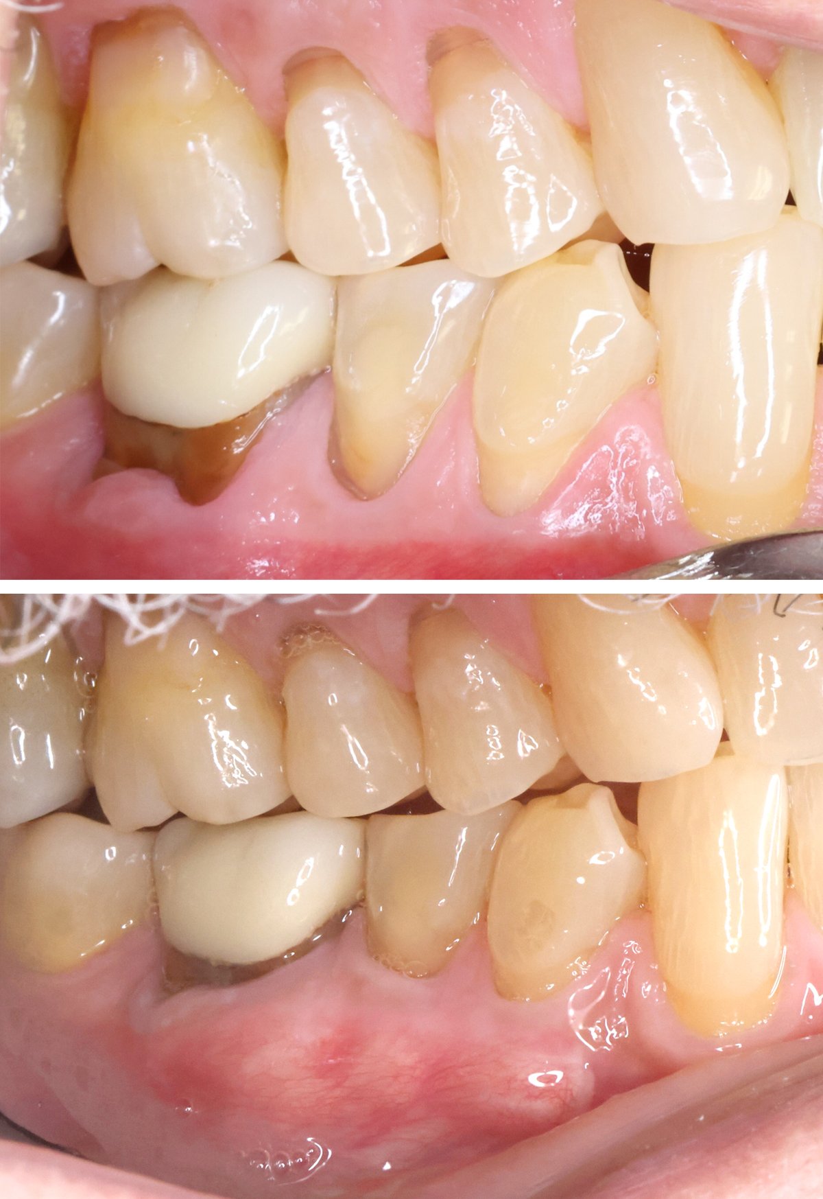 Free Gingival Graft (premolars)