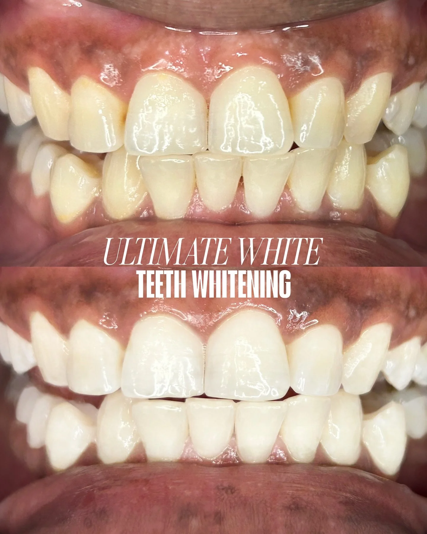 BRIGHTER SMILES IN 1HR 🦷✨

Instant cleaner &amp; brighter looking! With up to 10 shades lifted in just ONE session 😮&zwj;💨

Professional teeth whitening is safe for sensitive teeth as we use only the highest dental grade products, protecting your 