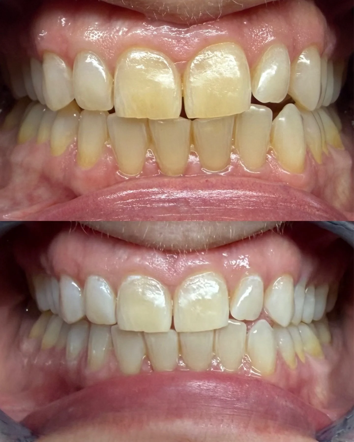 40Min Professional Teeth Whitening 🪥🧚

Pearly smiles ready for the holiday events, removing year old stain from black tea ☕️
_________
✨ $80 Service
📆 Booking Jan