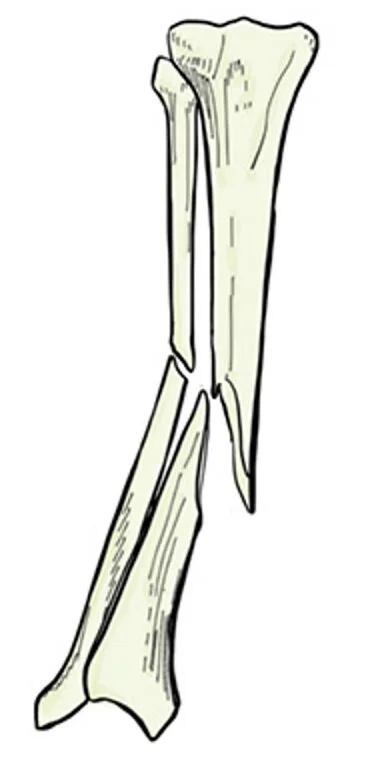 10563825-001, illustration picture of protect tibia of Bruz…
