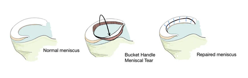 Bucket Handle Meniscus Tear