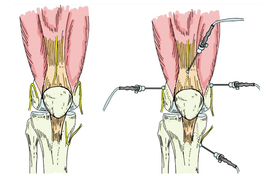 Gradient Denervation Radiofrequency Denervation