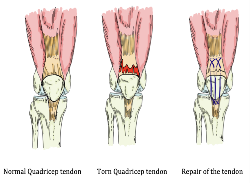 Signs Of Quadricep Muscle Tear – Quadriceps Tendon Rupture – RUWQ