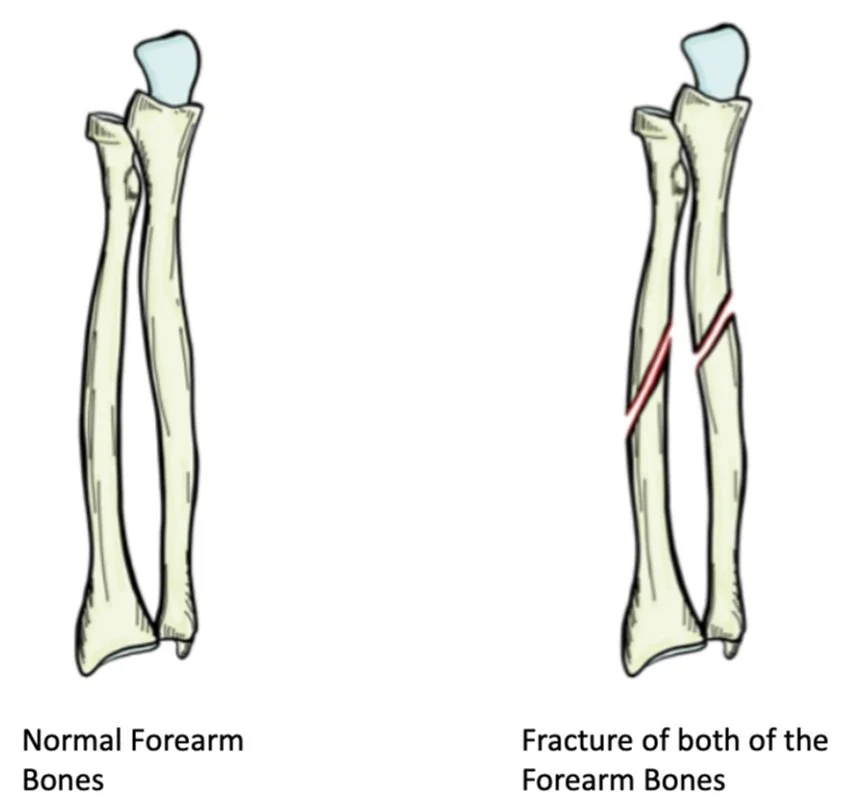 Ulna Bone Fracture