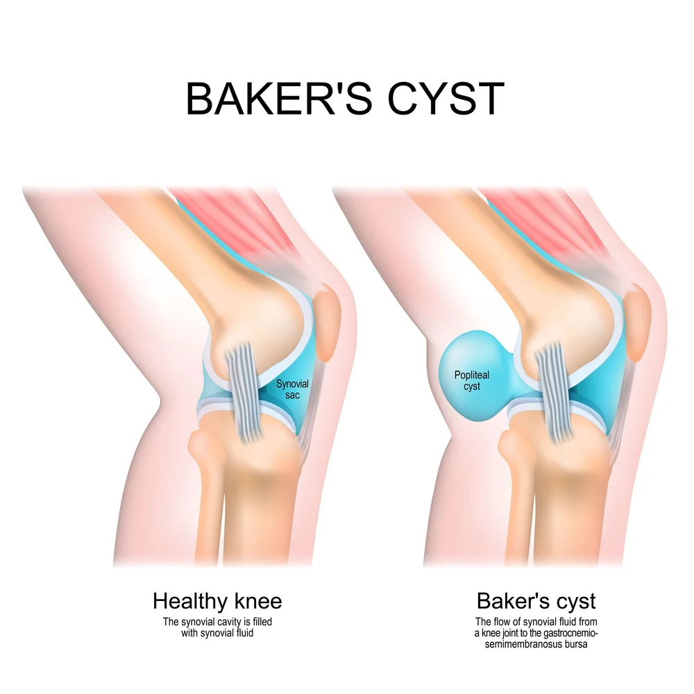 Baker's Cyst (Popliteal Cyst) Removal Surgery VBJS