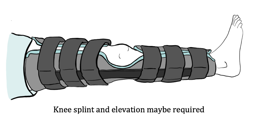 Kneecap Stabilisation Kneecap Stabilisation