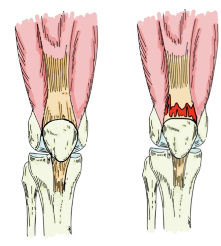 Quadriceps Tendon Injury