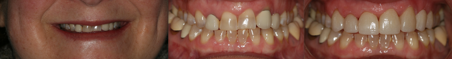 Close-up of a person's smiling mouth showing teeth, with a focus on the upper and lower teeth and gums.