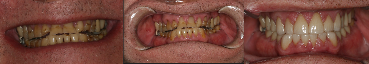 Close-up images of a person's teeth with severe dental decay and uneven alignment, showing major dental issues