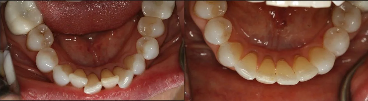 Close-up of lower and upper teeth, showing dental condition with alignment and spacing.