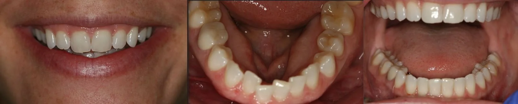 Close-up of a person's smile showing teeth, an image of the upper and lower teeth, and open mouth views.