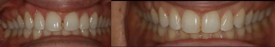 Close-up of a person's upper and lower teeth with some misalignment and crowding