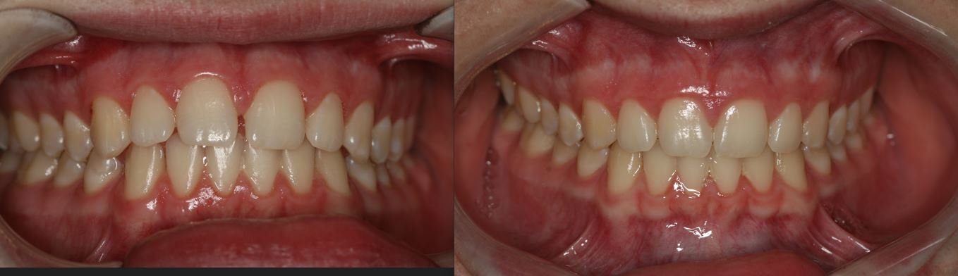 Close-up view of a person's front teeth showing dental misalignment and crowding in the upper and lower arches.