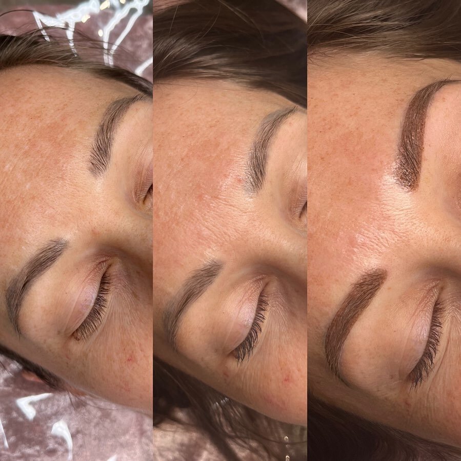 Saline Removal and fresh Powder Brows 🤩
These brows had previous microblading that had healed in the skin too cool and the shaped had blurred. To be able to correct the shape and colour we did 2x Saline removal sessions and then some fresh new powde