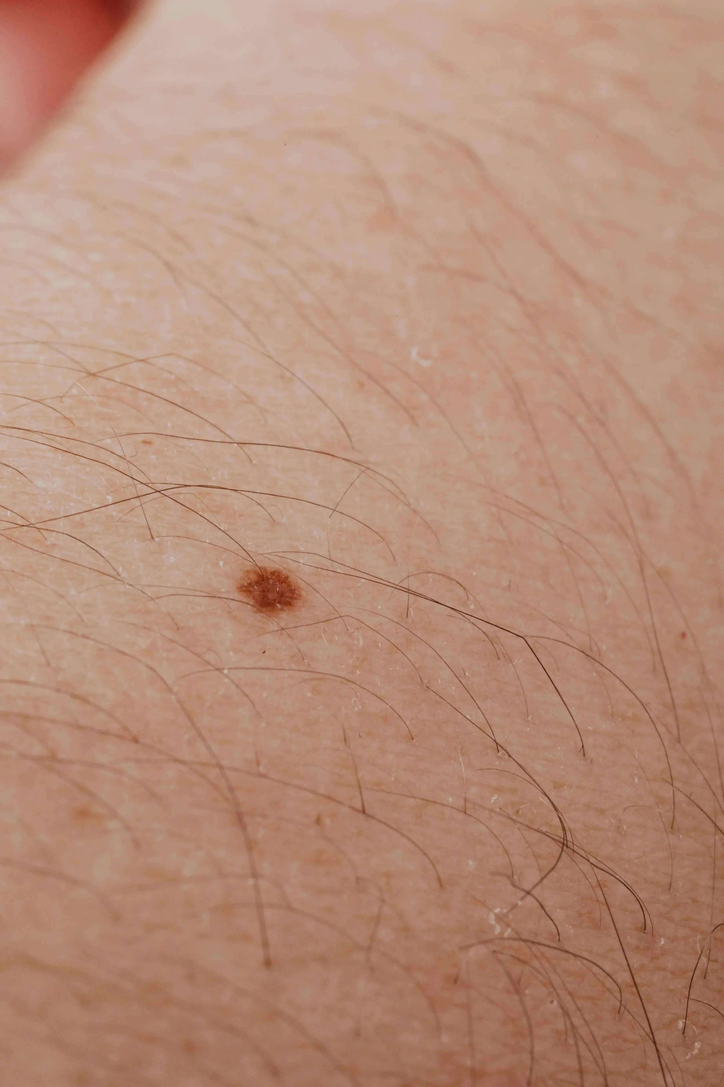 How to Tell if a Skin Mole Is Normal or Cancerous: The Complete Expert Guide